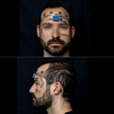 Forehead E-Tattoo Brain Stress Levels