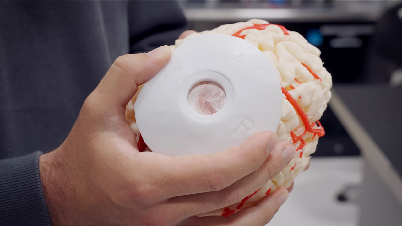 Neuralink First Transdural Brain Implant Procedure